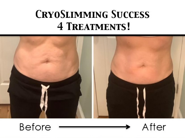 Cryoskin Slimming & Toning, Bedminster, NJ